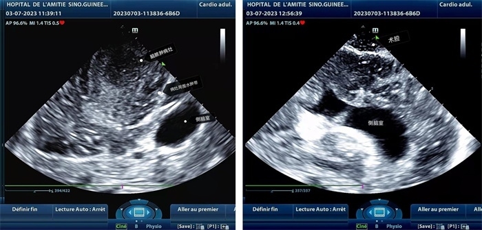 左圖顯示術(shù)中超聲見囊實性病變，大小約為4x4x3cm，病灶周圍腦組織水腫明顯；右圖為病灶切除后，術(shù)中超聲示術(shù)腔無病變殘留