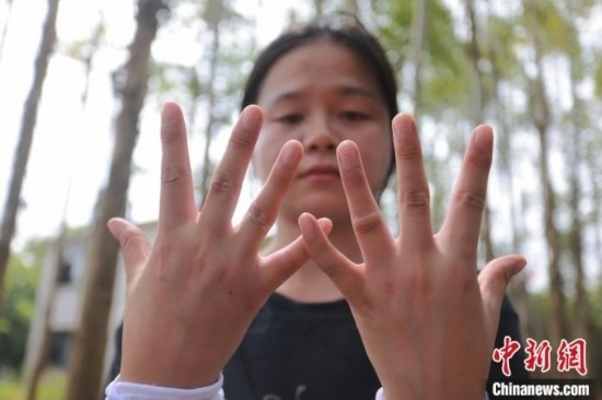 吳素英展示被蜜蜂蜇過的雙手。湯曉逵 攝