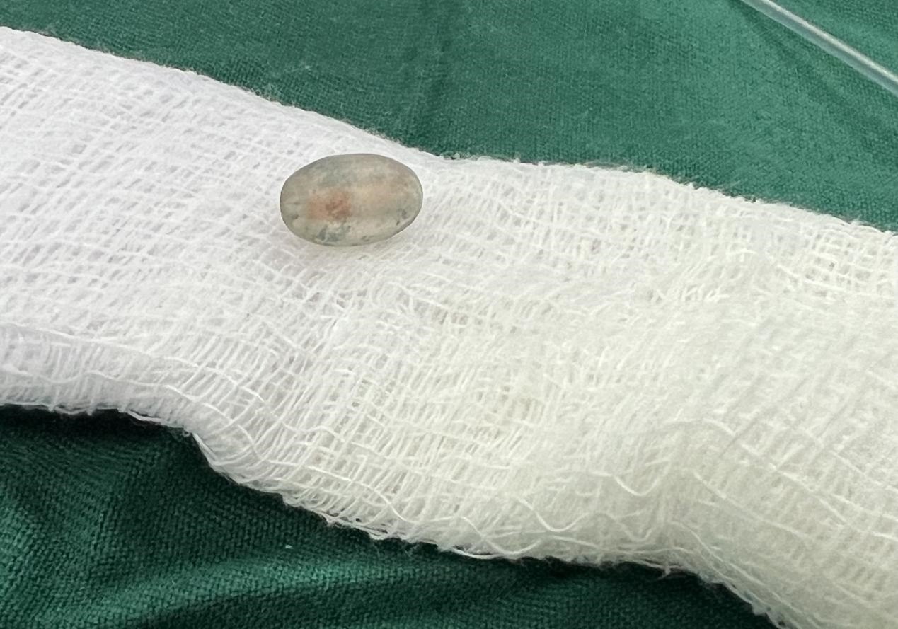 被取出的異物。中國援桑醫(yī)療隊供圖