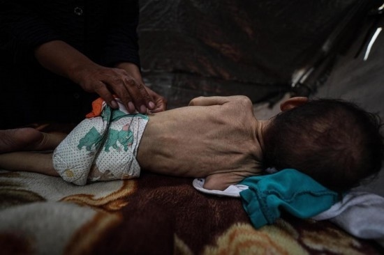 這是5月28日在加沙城西部一處臨時安置點(diǎn)拍攝的一名營養(yǎng)不良的嬰兒。新華社發(fā)（馬哈茂德·扎基攝）